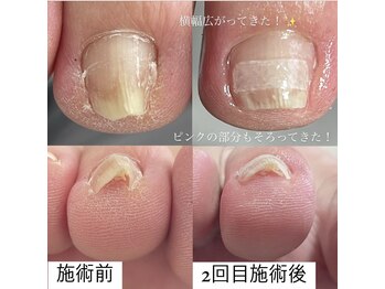 ロアルアナ(loa Luana)/巻き爪ケア