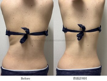 スラリ(SLARI)/【背面　脂肪冷却】期間2か月