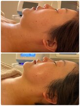 ルミア(LUMIA)/小顔造形ロイヤルフルコース2回