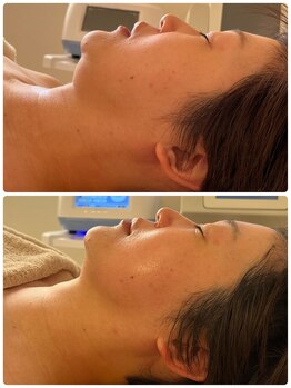 ルミア(LUMIA)/小顔造形ロイヤルフルコース2回