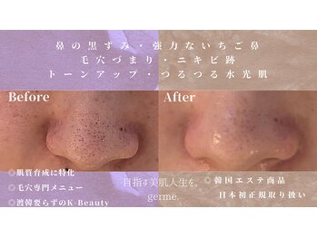 ジェルム(germe.)の写真/毛穴の奥の汚れや角栓をごっそりオフ◎触れるたびに嬉しくなる、ゆでたまごのような「つるすべ肌」へ