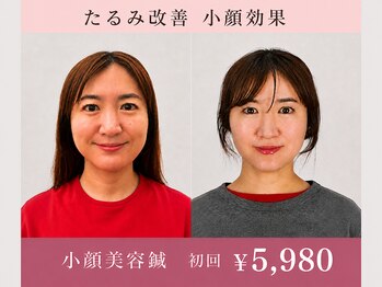 鍼灸院グロリアス 銀座(Glorious)の写真/《美容鍼×小顔矯正》骨格からほうれい線・シワにアプローチ!パンッと弾む若々しい印象へ導く◎