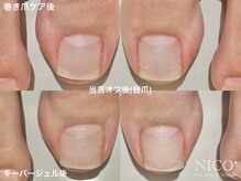 ニコプラス(NICO+)/巻き爪ケア