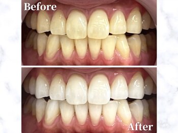 LBSホワイトニング 銀座店/セルフホワイトニングの症例写真