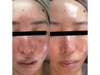 ホワイトアクア 梅田本店(WHITE AQUA)/ハーブピーリング/大阪/梅田