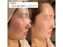 ウー バイ ルーヴェ(ou by Luve)/陶肌トリートメント