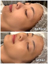 アヴァン(AVANT)/クリスティーナ1回施術後