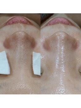 ボーソリューション(Beau-Solution)/【20代　鼻の黒ずみ詰まりケア】