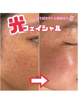 ヴィオール 名古屋栄店(VIOR)/光フェイシャル