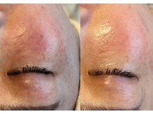 話題のプラズマニア！回数を重ねる度に肌悩みの軽減へ♪