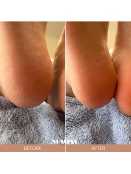 マオヌー(MAONU)/足裏集中保湿ケア　症例画像