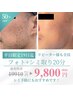 【LINE友達限定】平日メンズ限定光フォト＋シミケア20分半額★