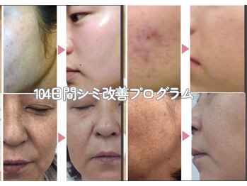 リジュベネーションサロン アリス(Alice)/104日間のシミ改善プログラム