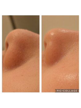 フェローズリンパケア(FELLOWS)/ピーリング+エポスキン