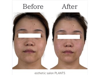 プランツ(PLANTS)/施術１回／たるみ・小顔・むくみ