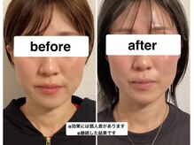 グリーン鍼灸整体院(green鍼灸整体院)/エラ鍼