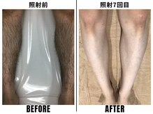 ストック 立花店(STOCK)/【全身】すね照射前→7回目