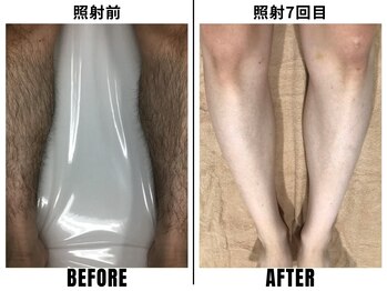 ストック 立花店(STOCK)/【全身】すね照射前→7回目