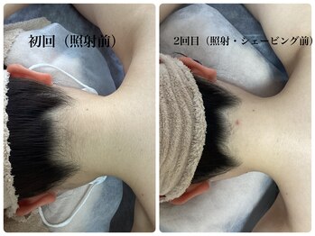 ［脱毛専門・肌育サロン］LULU.tokyo池袋2nd店/うなじ脱毛