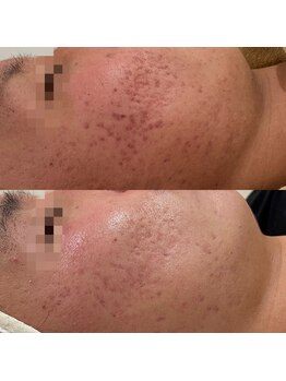 ラ クレール ビューティーサロン(LA CLAIR)/症例ニキビケア