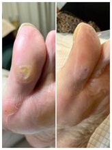 ドクターネイル爪革命 麻布十番店/【たこ・魚の目ケア】フットケア