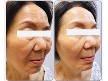 トータルサロンアイビーシー(トータルサロンIBC)/フォトでリフトアップ！