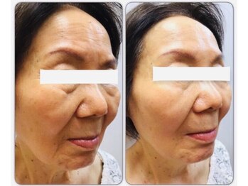 トータルサロンアイビーシー(トータルサロンIBC)/フォトでリフトアップ!