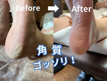 フットレスキュー(Foot ResQ)
