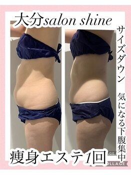 サロンシャイン(Salon Shine)/30代女性痩身エステ１回