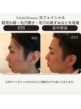 ワイスタイル(Ystyle)/光フェイシャル