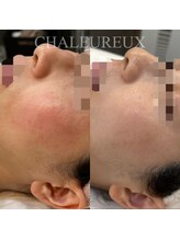 サロン ド ボーテ シャルル(Chaleureux)/肌悩み:赤み皮むけ・くすみ