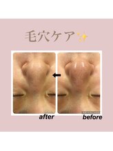 エステティック レイビス 新宿店(RAYVIS)/しつこい小鼻の黒ずみ撃退☆