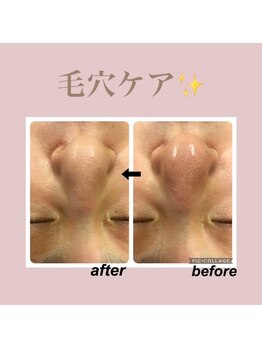 エステティック レイビス 新宿店(RAYVIS)/しつこい小鼻の黒ずみ撃退☆