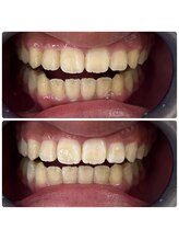 グリッター ショウナン(glitter. SHONAN)/藤沢ホワイトニングbefore/after