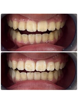 グリッター ショウナン(glitter. SHONAN)/藤沢ホワイトニングbefore/after