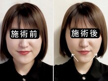 アオヤマ サロン ワイゼット(AOYAMA SALON YZ)の雰囲気（エラ張り・頬骨・むくみを整えてVライン小顔へ）