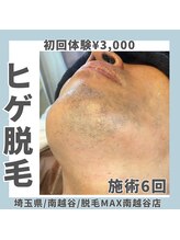 脱毛マックス 南越谷店(MAX)/メンズ脱毛/