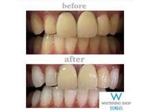 ホワイトニングショップ 宮崎店/【 差し歯 ・ 詰め物 OK】