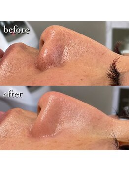 ニューズビューティー(neu's beauty)/[毛穴洗浄]ハイドロスプラッシュ