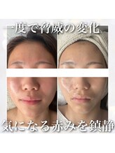 レイ(Rey)/赤み改善☆一度で結果出します！