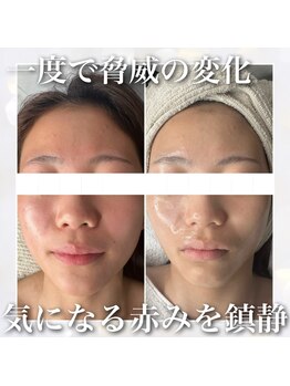 レイ(Rey)/赤み改善☆一度で結果出します！