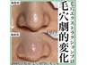 人気急増【今だけ特別クーポン】 話題の毛穴洗浄/劇的変化実感¥13000→¥8500