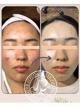 エヌ スタイル(N Style)/リベルハーブピーリング 