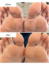 ケアプラス(care plus)/足裏角質ケア