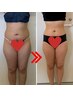 本気で痩せたい人必見！脂肪冷却を3回セットでご提案！！