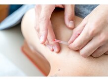 平川接骨院/針灸治療院 草津駅前/針施術