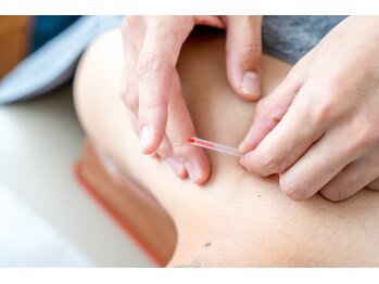 平川接骨院/針灸治療院 草津駅前/針施術