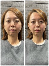 長寿鍼灸院 長寿整骨院/美容鍼50本の効果★ハリ・ツヤ