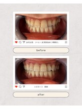 スマイルプライベートビューティサロン(Smile)/セルフホワイトニング（初回）