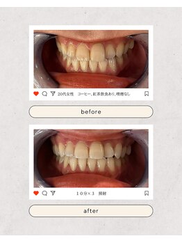 スマイルプライベートビューティサロン(Smile)/セルフホワイトニング(初回)
